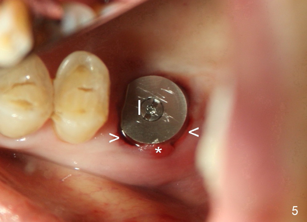 Pictures Of Dry Socket The Basics Of Tooth Extraction Dr